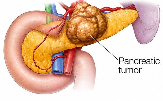 What is Pancreatic Cancer Surgery?